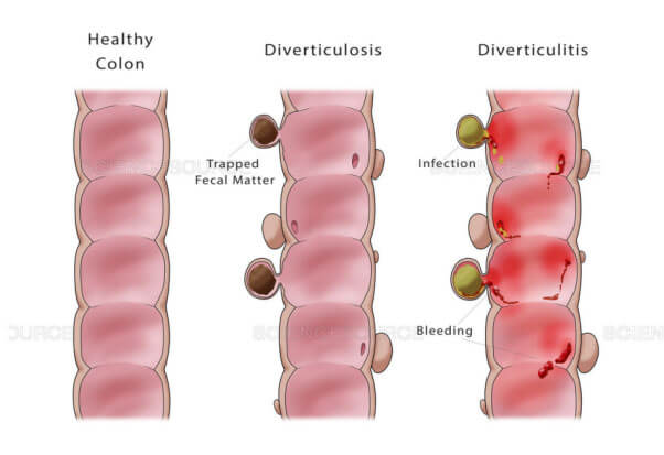 Diverticulitis Treatment at Dublin Vitality Center